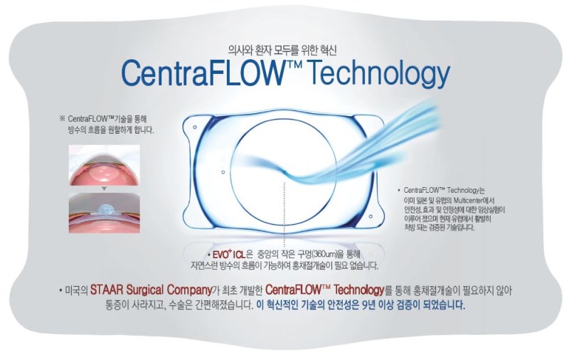 안내 렌즈 삽입술 (ICL)의 모든것❗ 사진 7